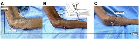 Two incision distal biceps repair.  Using a titanium Augmenting the repair with a...