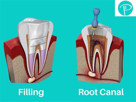 Two root canals in one day