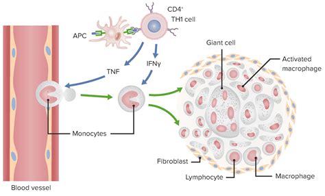 Type IV Hypersensitivity Reaction Concise Medical Knowledge