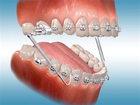 Types of Orthodontic Appliances - mouth and teeth