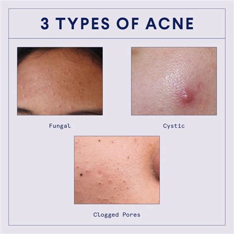 Types of acne: clogged pores, whiteheads, blackheads and cysts