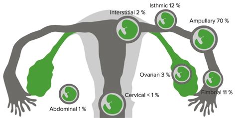 Types of ectopic pregnancy.  Some examples of the different types of ectopic pregnancy...