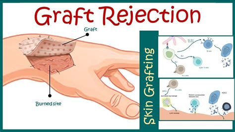 Types of grafts and grafts rejection - SlideShare