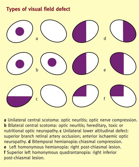 TypesofVisualDisturbances