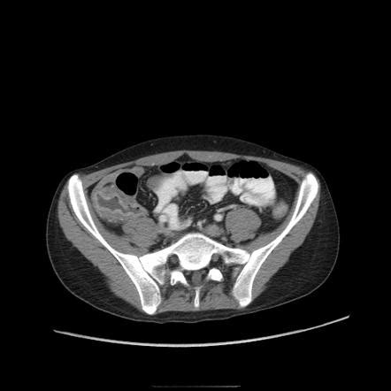 Typhlitis Radiology Reference Article.