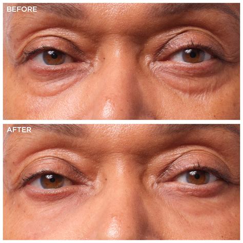Under Eye Bags Treatment | Dr Elizabeth Hawkes - balustradellc