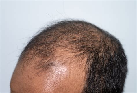 Understanding Hair Thinning in Men: Causes and … - balustradellc