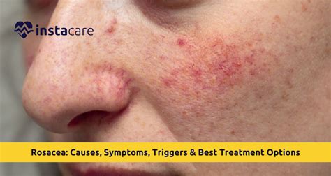 Understanding Rosacea: Causes, Symptoms, and Treatment - balustradellc