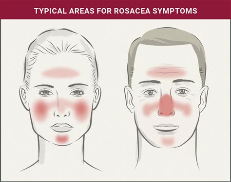 Understanding Rosacea - balustradellc