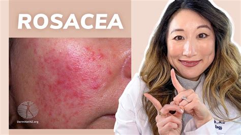 Understanding Treatment Options for Rosacea | UNC … - balustradellc