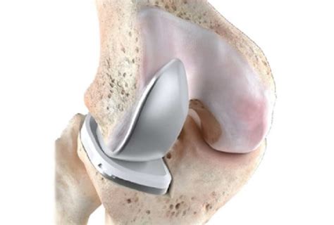 UNICOMPARTMENTAL KNEE ARTHROPLASTY (UKA) …