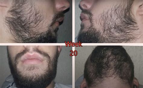 Unlocking the Benefits of Minoxidil for Hair and Beard Growth - balustradellc