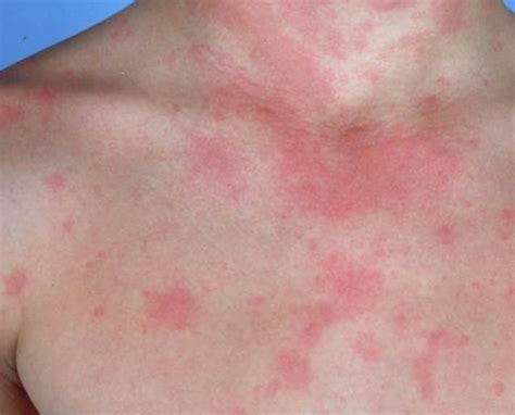 URTICARIA & HIVES - Causes and Treatment of Itchy Skin Rash