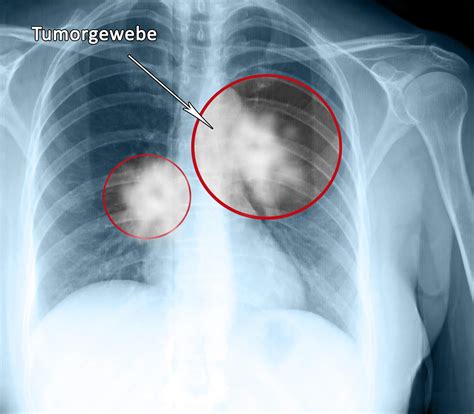 Ueber lungenkrebs vom bronchus ausgehend. - How to manually install ps3 update.
