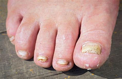 Ugly nails. In most cases, we don’t pay much attention to our fingernails or toenails. We trim them, clean them, and maybe polish them, but that’s usually about it. Unfortunately, sometimes, w... 