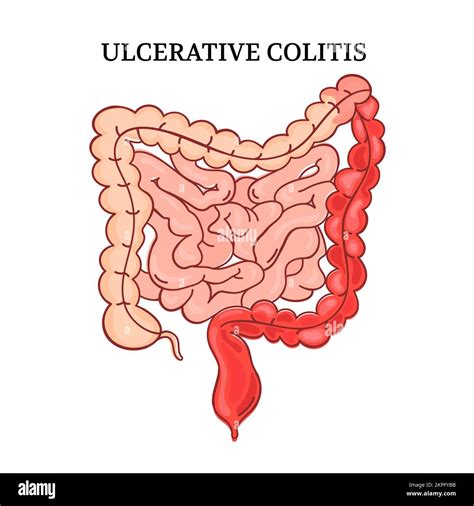 Ulcerative Colitis MedicoLearning