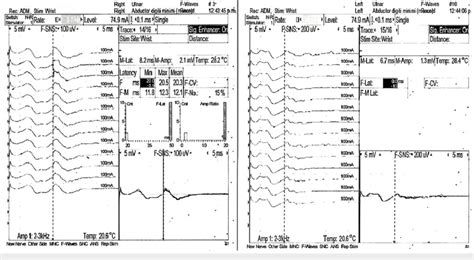 Ulnar nerve F-wave latencies recorded from the abductor digiti …