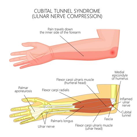 Ulnar neuropathy at the elbow (UNE) represents the second most common entrapment neuropathy in the upper extremity encountered in clinical practice. The features suggesting a lesion of the ulnar nerve (UN) are based upon knowledge of the UN and its sensory and motor branch distribution. However, due to anatomic variations, a broad …. 