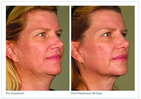 Ultherapy Before and After Photos Houston Texas Med Spa