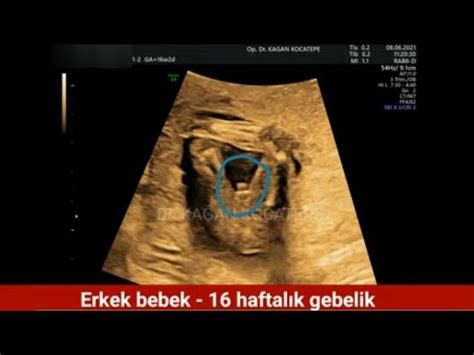 Ultrason rahim içinde bebeğin kilosunu doğru ölçer .