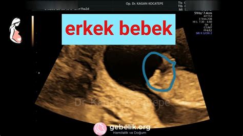 Ultrasonda erkek bebek testisleri