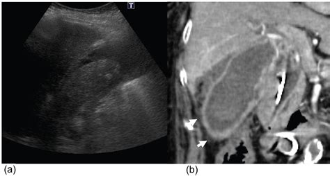 Ultrasonography of acute cholecystitis: clinical and ... - PubMed