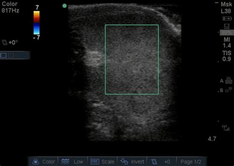 Ultrasound: testicular - WikEM