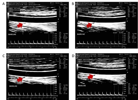 Ultrasound Assessment of Endothelial Function A Technical Guideline of
