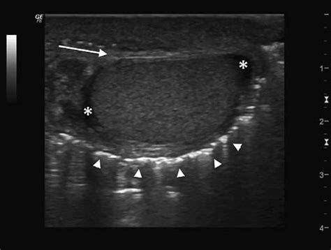 Ultrasound in the diagnosis of Fournier