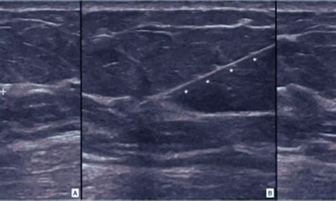 Ultrasound or Mammography Guided Localization Cedars-Sinai