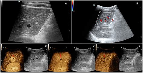 Ultrasound to Detect Liver Cancer Procedure Benefits Risks