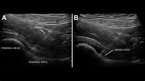 Ultrasound-Guided Hip Injection - manhattansportsdoc.com