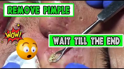 Unbelievable blackhead removal 2023. Mar 15, 2023. Calling all popaholics! ... Watch the Giant Cyst Sac Removal That Even Made Dr. Pimple Popper Say 'Wow' ... Check out Dr. Pimple Popper's top blackhead extractions. Trending Stories ... 