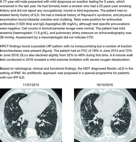 Unclassifiable interstitial lung disease on HRCT: aggressive ...