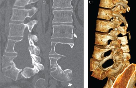 Uncover the Intricacies of Non Rib Bearing Lumbar Vertebral Bodies