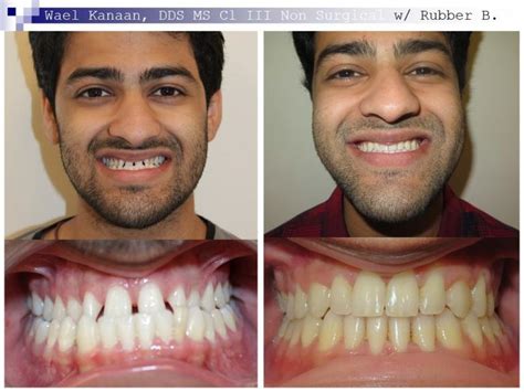 Underbite Correction Treatments: How to Fix an Underbite?