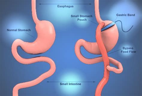 Understanding Bariatric Surgery the Department of Surgery