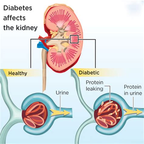 Understanding Bone Disease in Patients with Diabetic Kidney