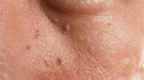 Understanding Skin Tags How They Appear And Common Symptoms During