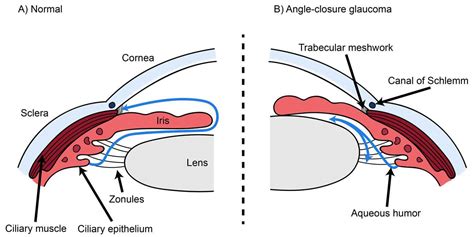 Undetected angle closure in