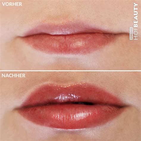 Unebenheiten nach hyaluron lippen