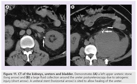 Unenhanced CT in the evaluation of renal/ureteric colic