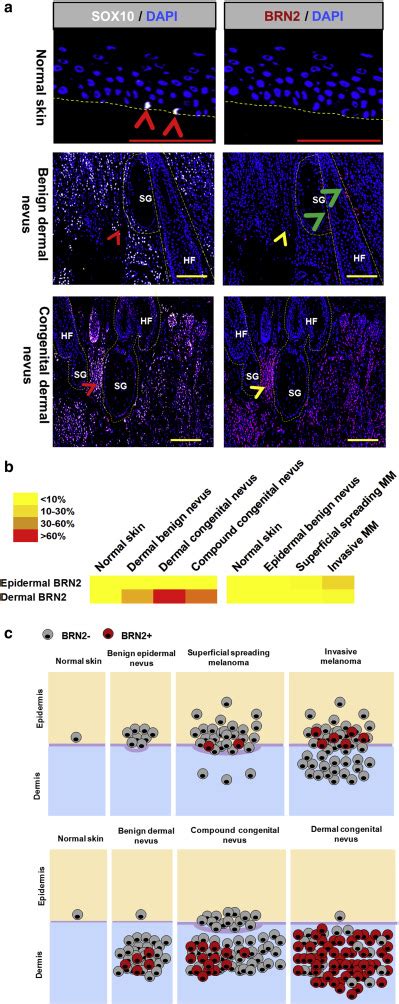 Unexpected High Levels of BRN2/POU3F2 Expression in Human …