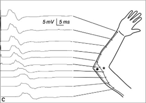 Unexpected Inching Explained by an Ulnar Nerve Anatomic Variant ...