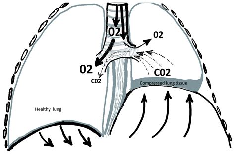 Unilateral Diaphragmatic Paralysis Article - StatPearls