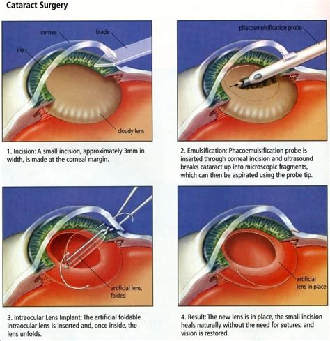 Until How Long After Cataract Surgery Can You Bend …