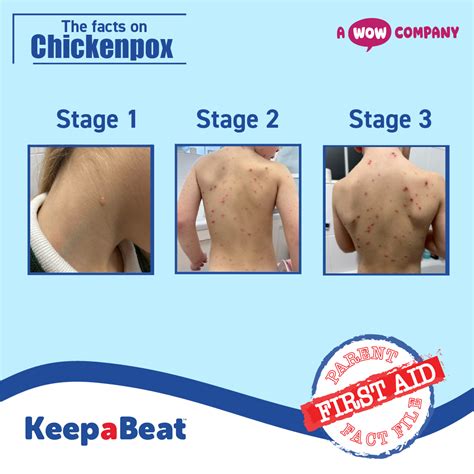 Until when is chickenpox contagious