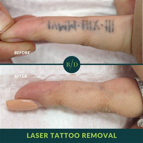 Update more than 80 tattoo laser removal before and after in.cdgdbentre