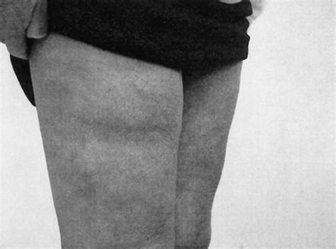 Upper thigh indentation. An indentation, dent or groove in a thigh “is not typically associated with muscle loss, and therefore it is not a common sign of ALS,” says Dr. Gerecke. “Patients can develop thigh dents from local trauma.”. Dr. Gerecke has a special interest in ALS, myasthenia gravis, myopathy/muscular dystrophy, peripheral neuropathy and radiculopathy. 