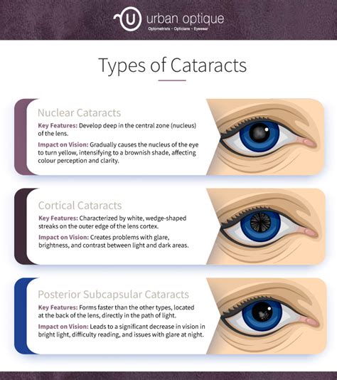 Urban Dictionary: cataract